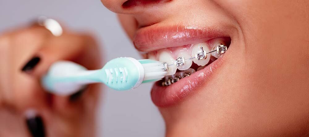 The Complete Guide for Managing Dental Braces During and Post Treatment