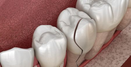 The Consequences of an Untreated Fractured Tooth