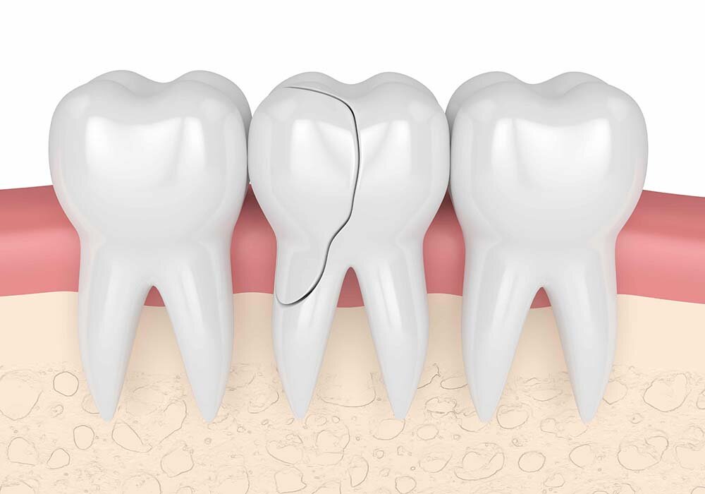 The Importance Of Treating A Fractured Tooth