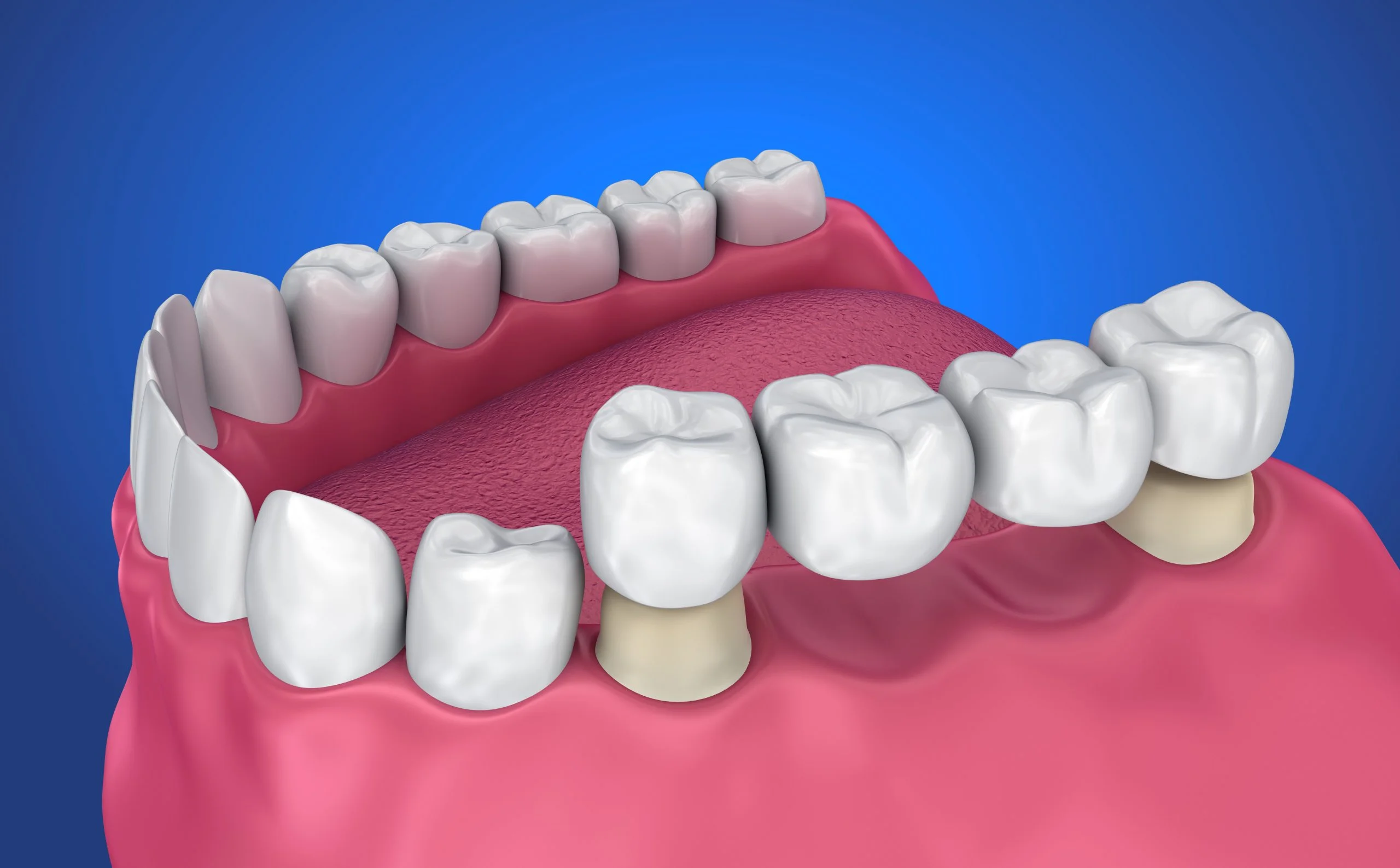 Replace A Missing Tooth With Dental Bridges