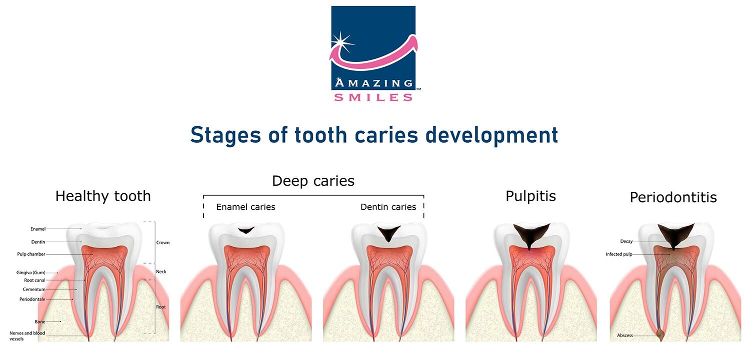 Dental cavities Information