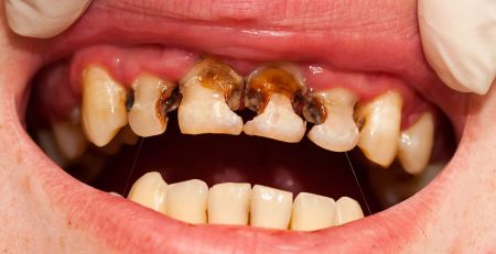 what is tooth decay