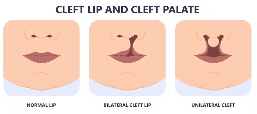 Cleft lip and Cleft palate