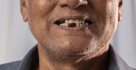 Is Natural Tooth Loss Hereditary?