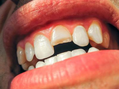 How to fix a chipped or broken tooth