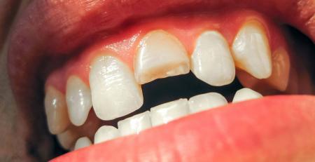 How to fix a chipped or broken tooth