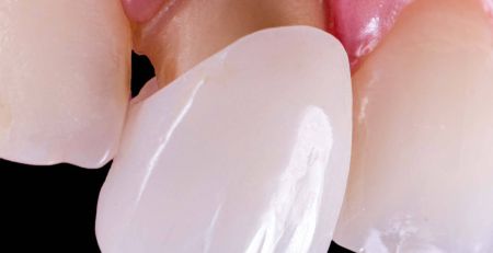 Tooth Decay underneath Crowns and Bridges