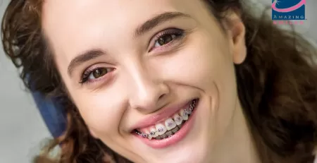 Clear Aligners vs Traditional Dental Braces, which one should I get