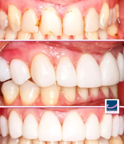 Choosing between Composite Veneers vs Porcelain Veneers