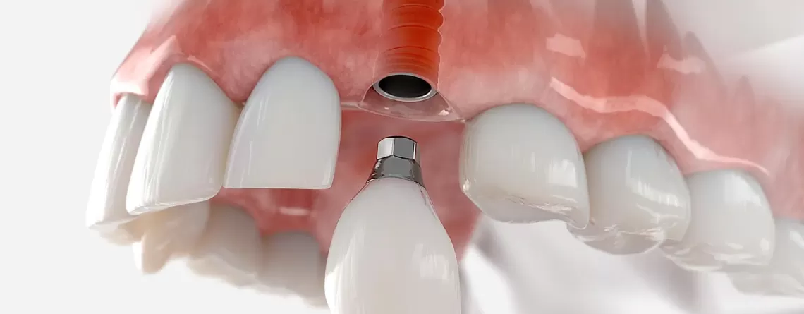 What do I do if my dental implant has broken