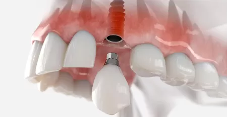 What do I do if my dental implant has broken