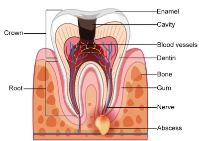 What is a Gum Abscess