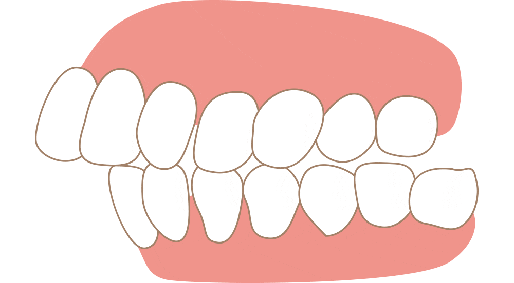 Orthodontics - Dental Braces - Malocclusion - Amazing Smiles