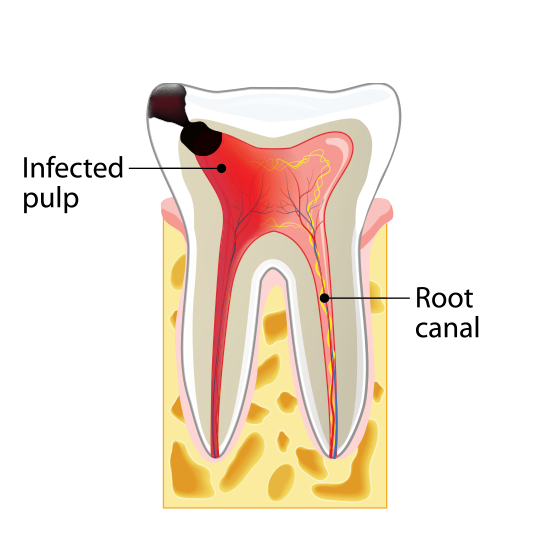 Stage Three Tooth Decay