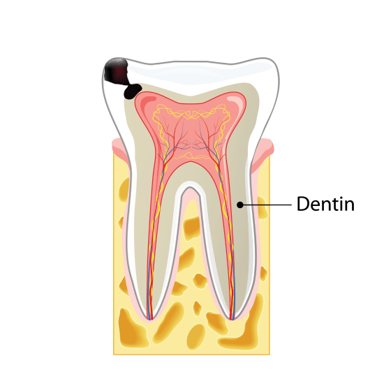 Stage Two Tooth Decay