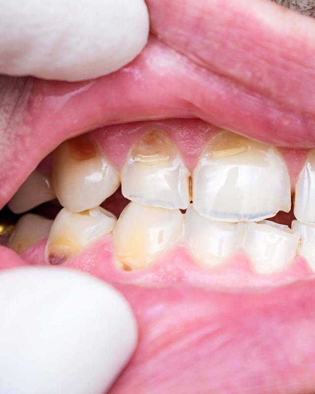 Fix Broken or Decayed Teeth - Smile Restoration - Amazing Smiles