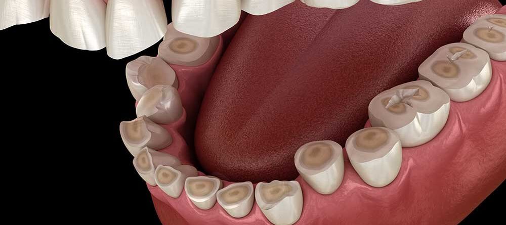 Dental attrition (Bruxism) resulting in loss of tooth tissue. Medically accurate tooth 3D illustration