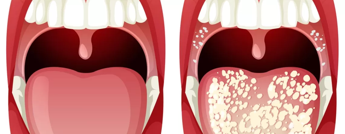 What is Oral Thrush? Understanding the Symptoms and Treatment Options
