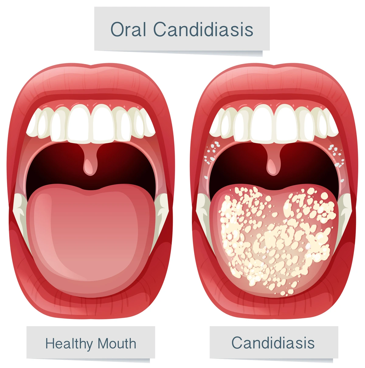 Mouth Of An Aids Patient Showing Oral Candidiasis By Mary's Hospital  Medical School/science Photo Library, Candida In Mouth