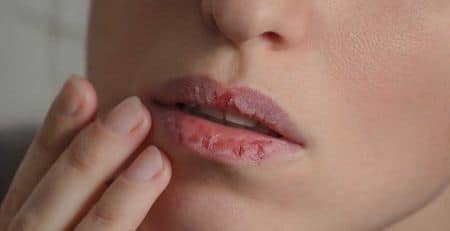 Are You Suffering from Dry Mouth? Causes, Home Remedies, and Treatment Solutions