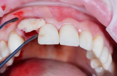 Bone Grafting for Dental Implants