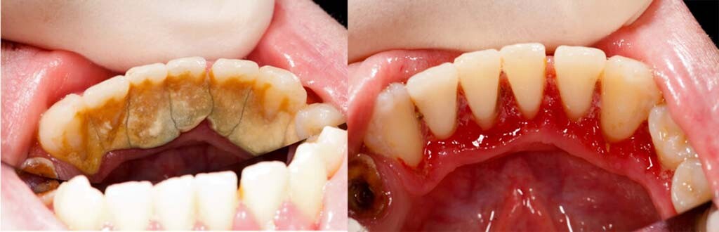 Does tartar Removal Damage Teeth?