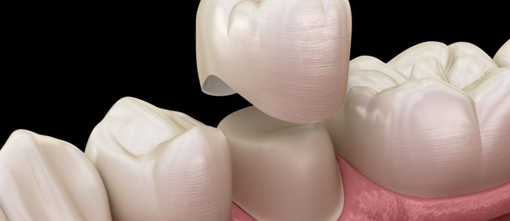 Dental Crowns a Complete Aftercare Guide