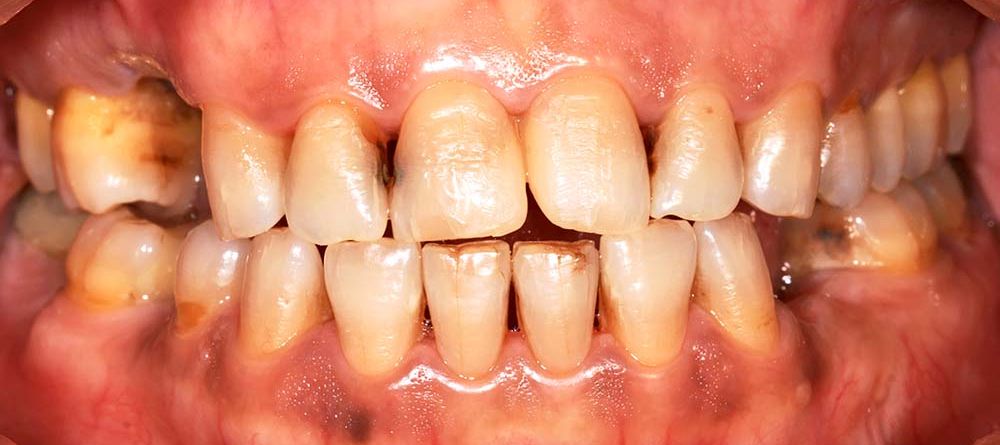 Dental Erosion: Causes, Risks, and Treatment Options
