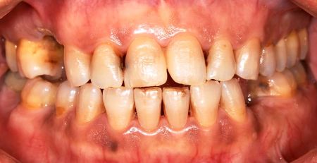 Dental Erosion: Causes, Risks, and Treatment Options