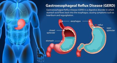 Dental Erosion caused by Acid Reflux