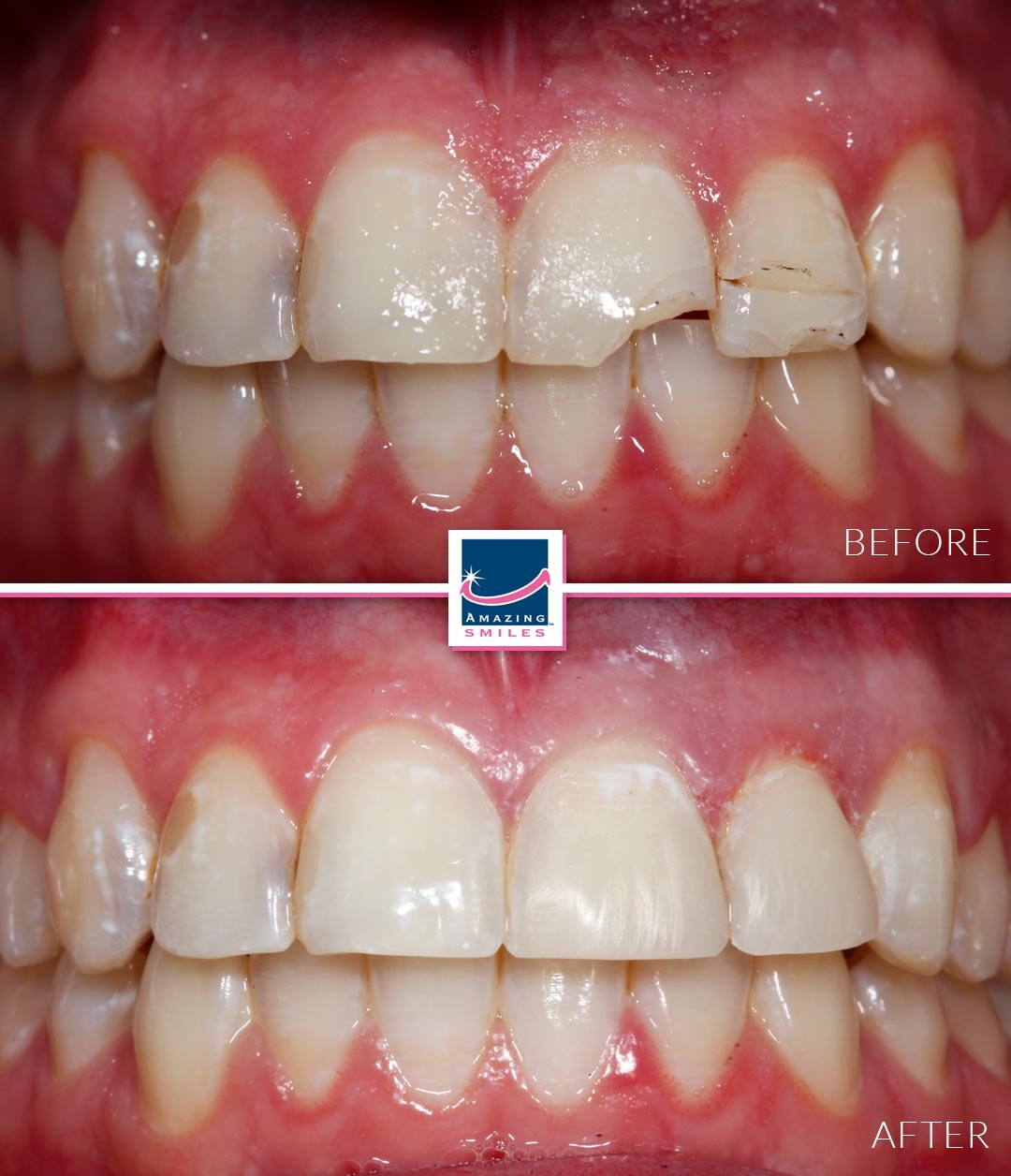 Smile Restoration - Before And After