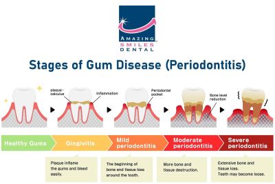 Stages of Gum Disease Periodontitis