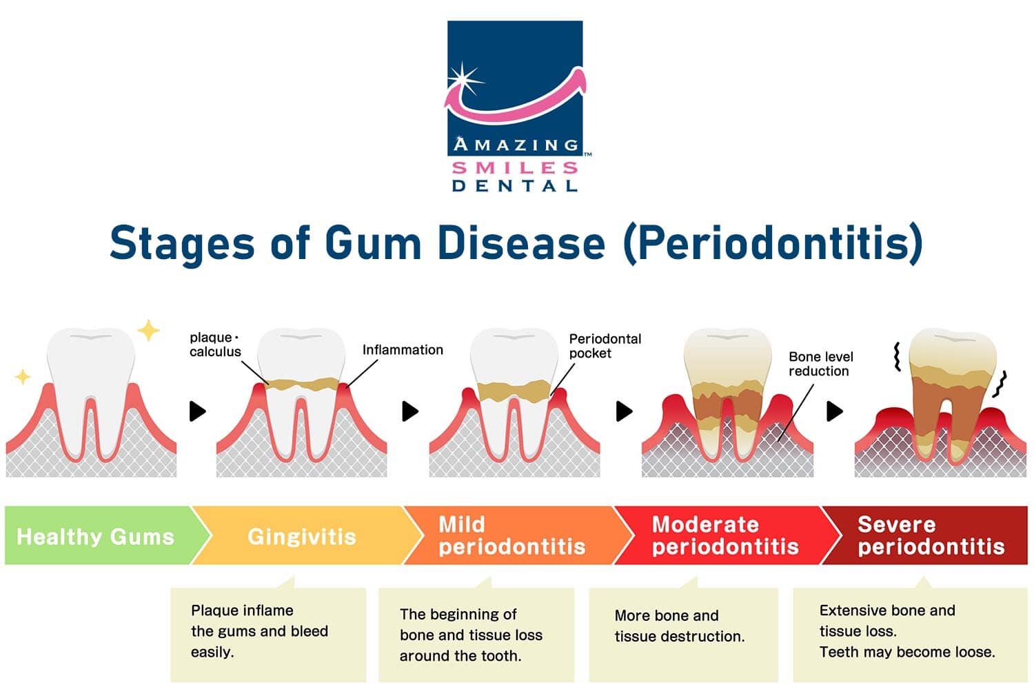The 5 Stages of Gum Disease: Signs, Symptoms, and Treatment - Old