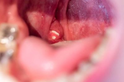 The Causes of Tonsil Stones and Treatment Options