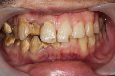 Understanding Gingivitis: Symptoms, Prevention, and Treatment Options