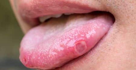 Understanding Tongue Ulcers