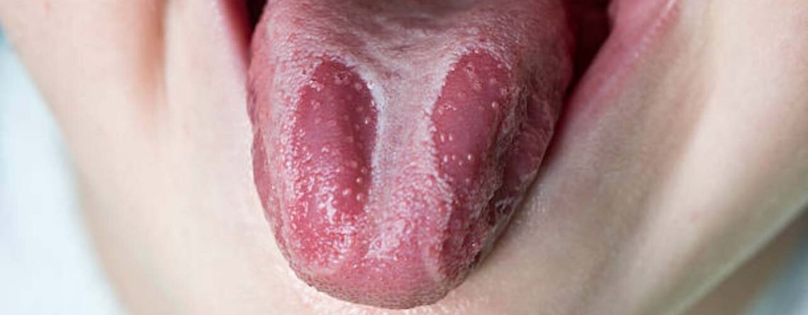What is Burning Mouth Syndrome