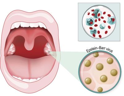 What is Mononucleosis? Symptoms, Diagnosis, & Treatment