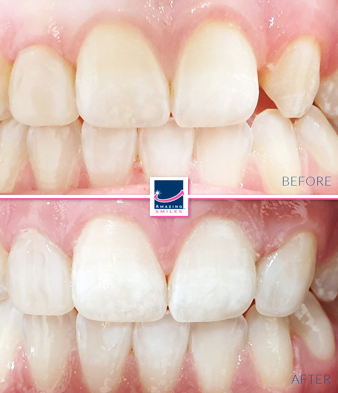 Smile Restoration - Before And After