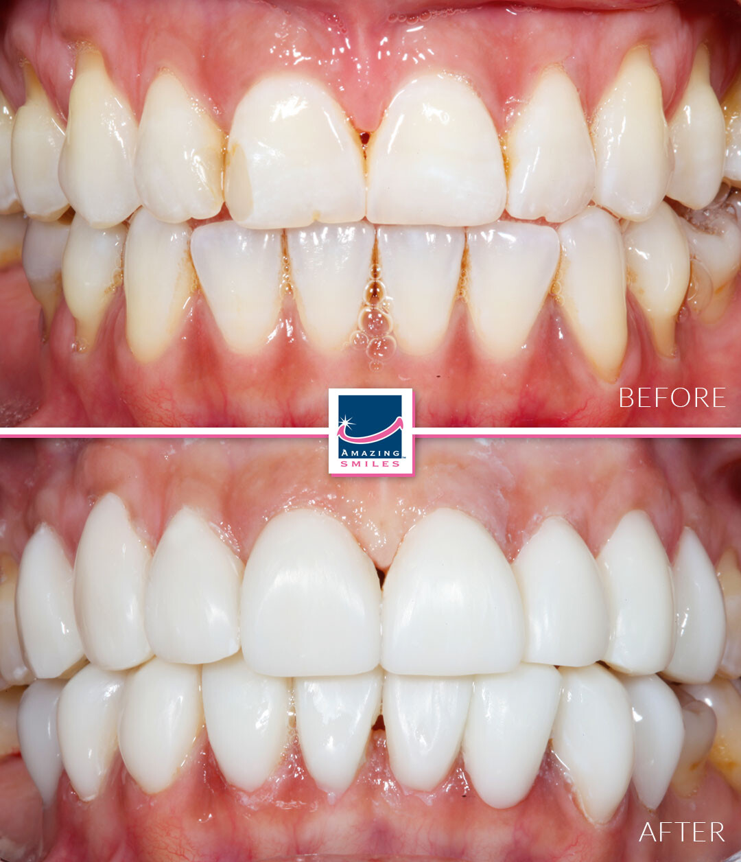 Smile Restoration - Before And After