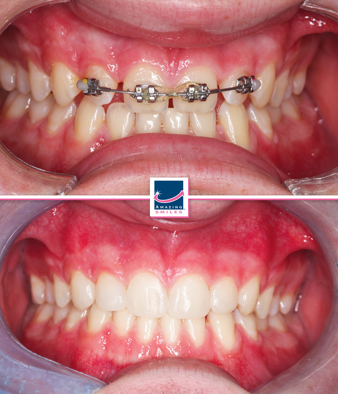 Smile Restoration - Before And After