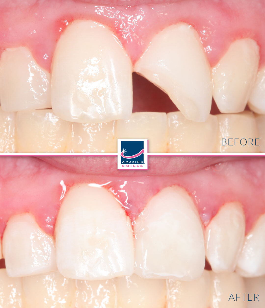 Smile Restoration - Before And After