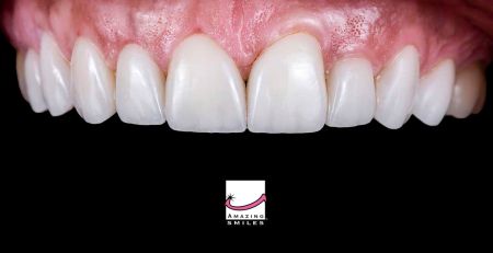 A Complete Guide to Porcelain-Veneers Brisbane and Gold Coast