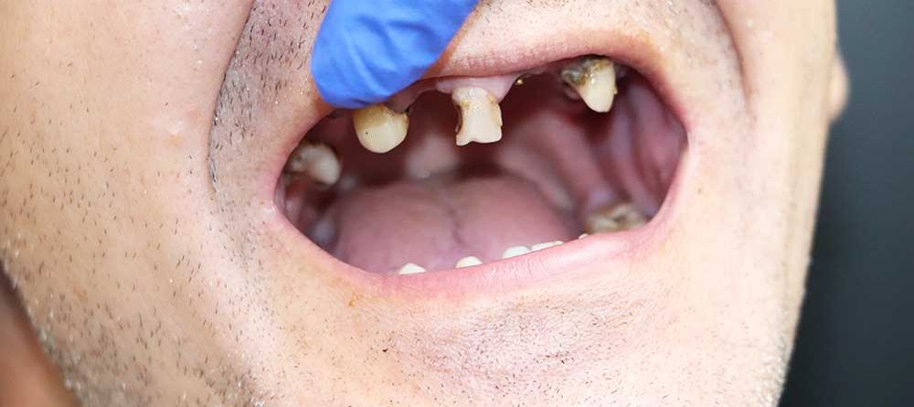 Understanding Terminal Dentition