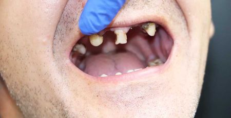 Understanding Terminal Dentition
