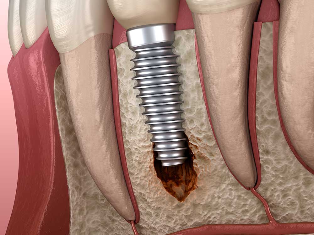 What is Peri-implantitis