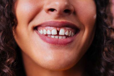 A Gap In Front Teeth - Diastema Causes and Treatment