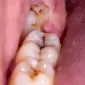 Comprehensive Guide to Wisdom Tooth Removal