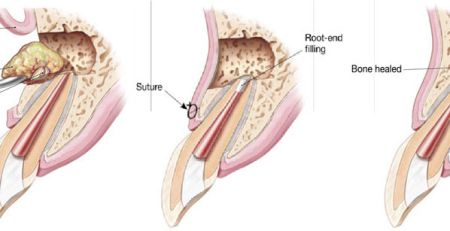 What is an Apicoectomy? An In-Depth Guide