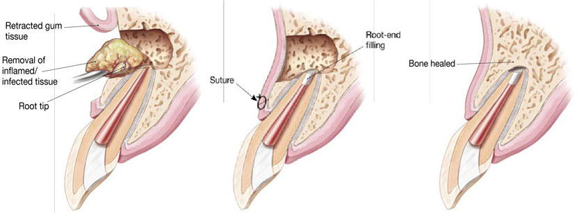 What is an Apicoectomy? An In-Depth Guide